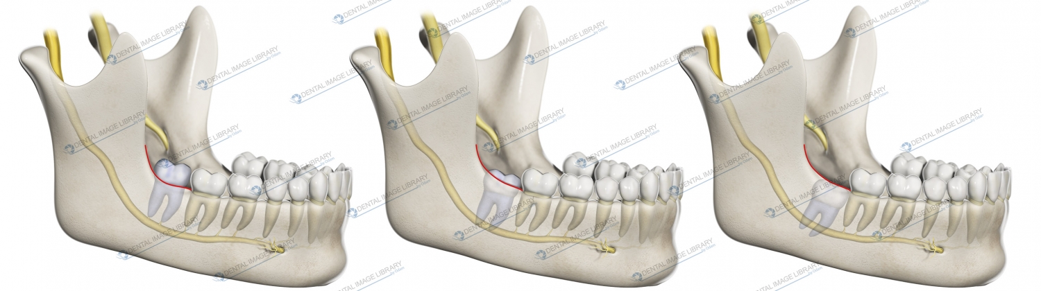 Pell And Gregory Classification Relationship With The Mandibular Ramus