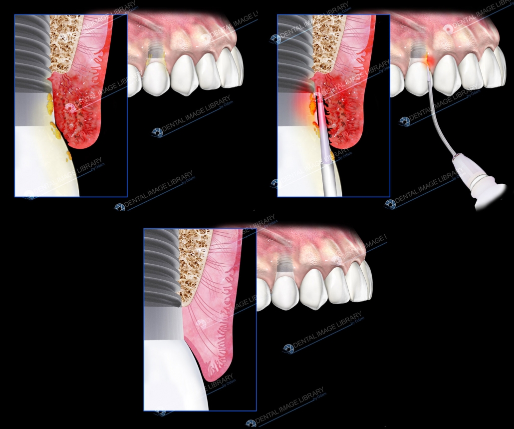 Collection Of Illustrations Non Surgical Therapy Of Peri Implantitis