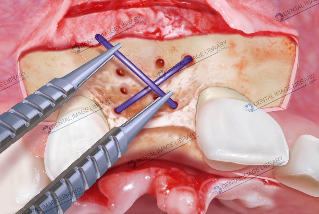 Collection of four images partialthickness flaps (mucosal) and flap