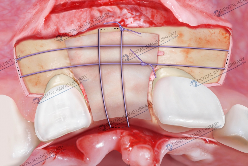 Perforation of the buccal cortical plate. 101JN00019 Dental Image Library