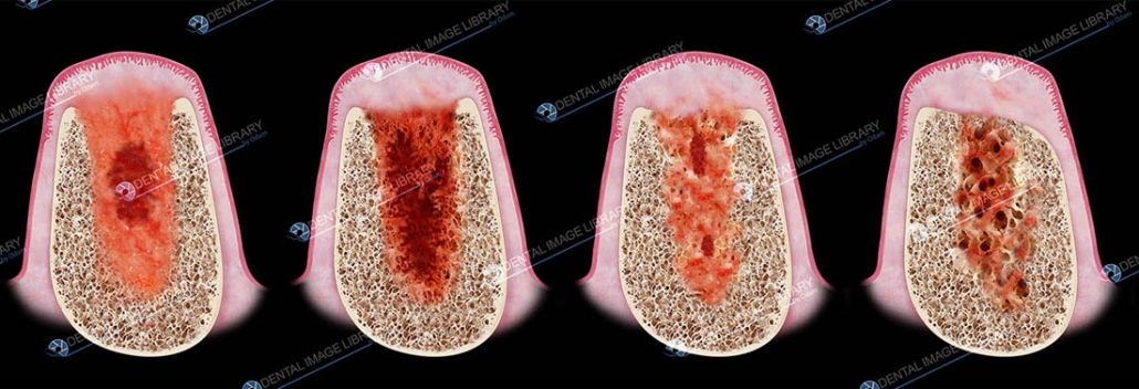 Healing Of The Extraction Socket. 102JB00041 | Dental Image Library