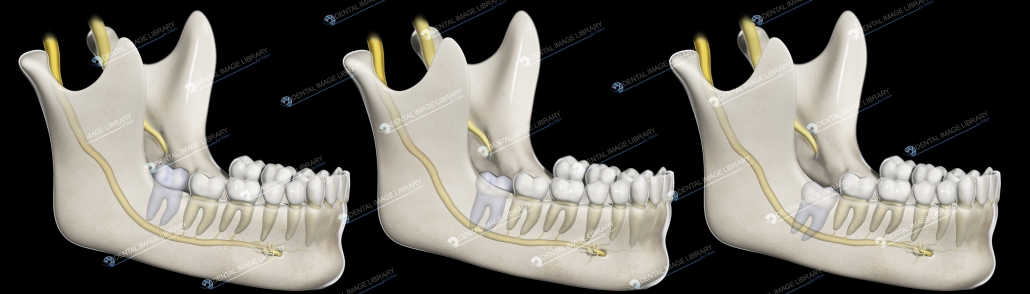 Pell and Gregory classification: relation of the cementoenamel junction ...