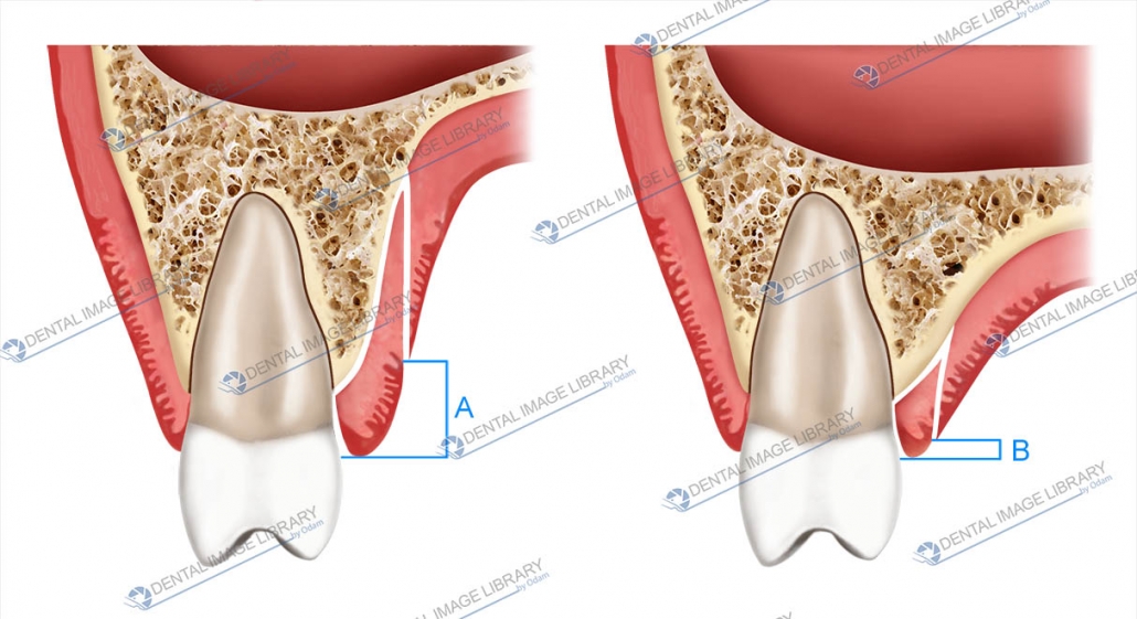 Palatal thinned flap. 61JW00028 Dental Image Library