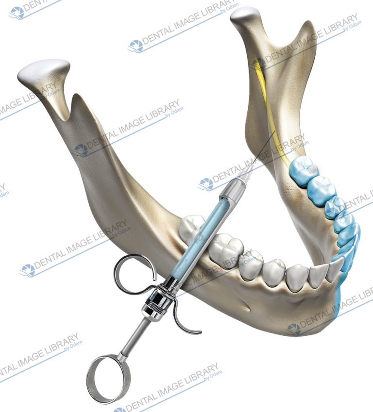 Dental Anesthesia inferior alveolar nerve block. 82JW00005 Dental