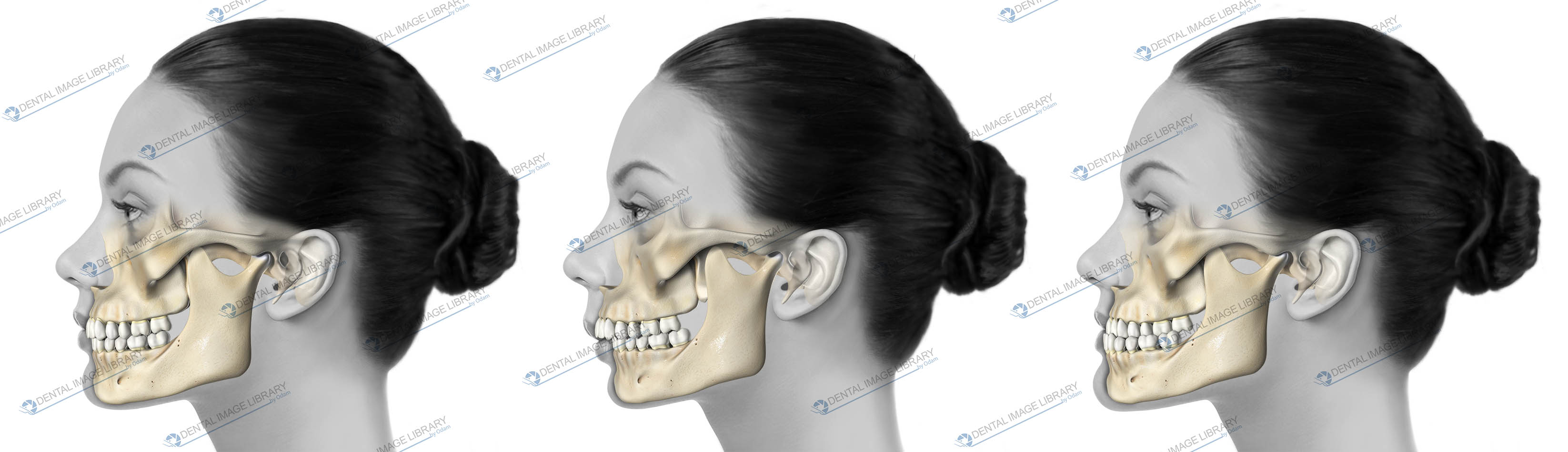 three-types-of-malocclusion-class-1-class-2-and-class-3-93jw00024