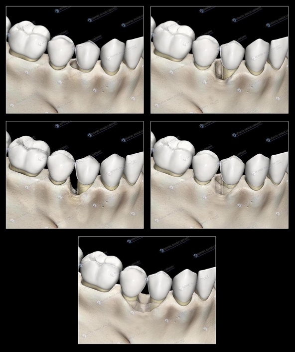 Types of bone defects. Black background Dental Image Library