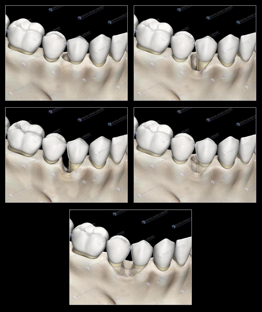 Types of bone defects. Black background | Dental Image Library