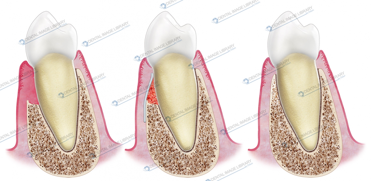 Tooth Membrane Dental Barrier Membrane Guided Tissue Regeneration – WZXENZ