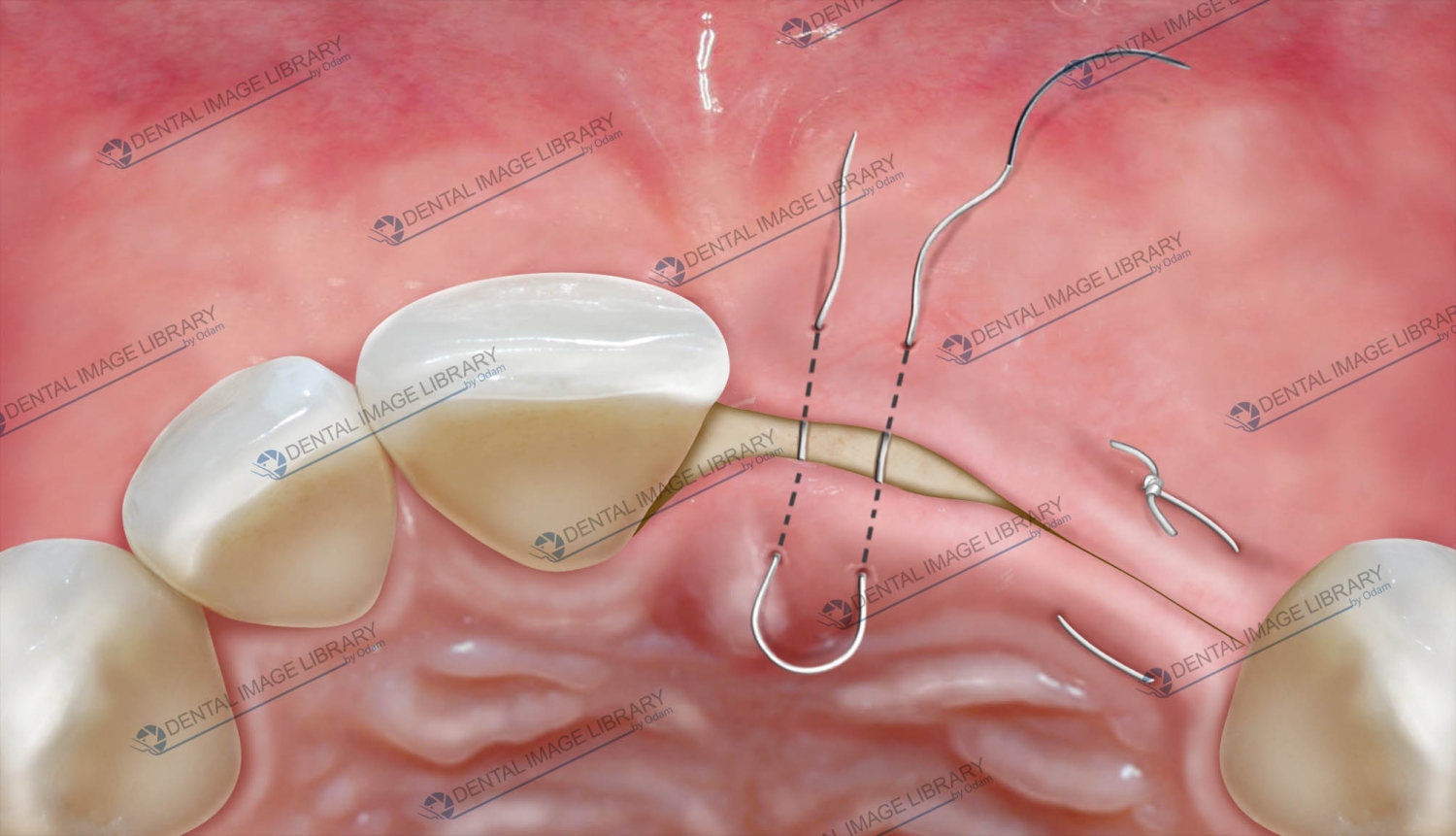 The external horizontal mattress suture. 81PN00010 Dental Image Library