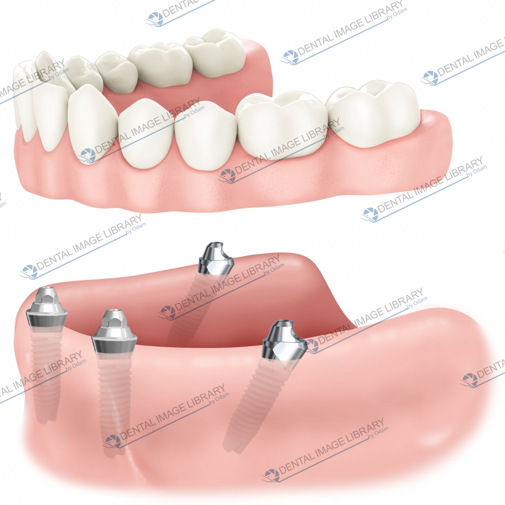 All on four. 62JW00110 | Dental Image Library