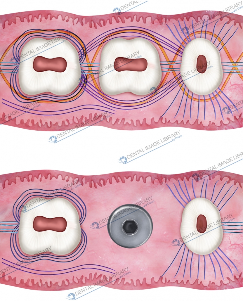 Collection of two drawings: teeth gingival fibers vs peri-implant ...