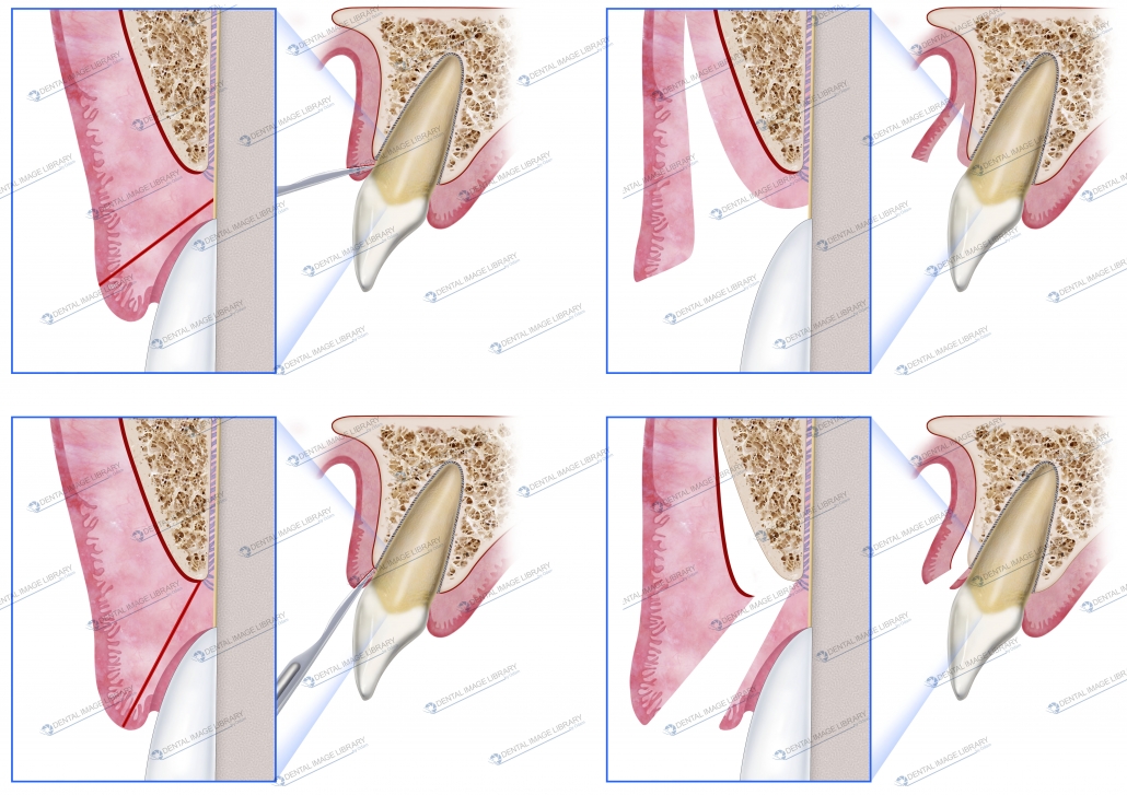 Collection of four images partialthickness flaps (mucosal) and flap