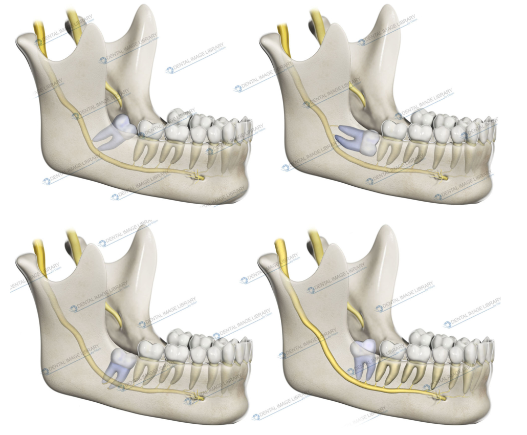 Winter’s classification. Third molars are classified according to their ...