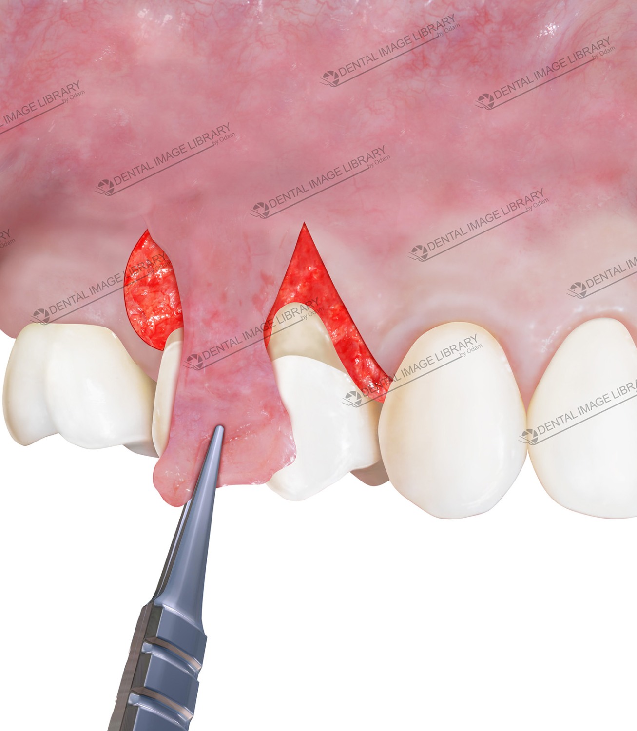 Step-by-Step Guide to a Lateral Positioning Flap with Connective Tissue ...